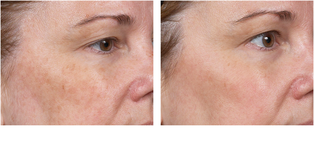 Clear Brilliant Laser in Florida Suncoast Skin Solutions